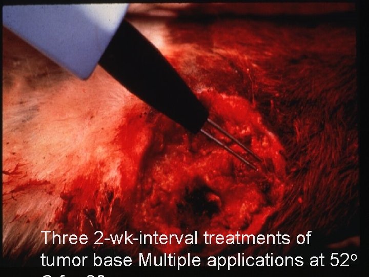 Three 2 -wk-interval treatments of tumor base Multiple applications at 52 o 