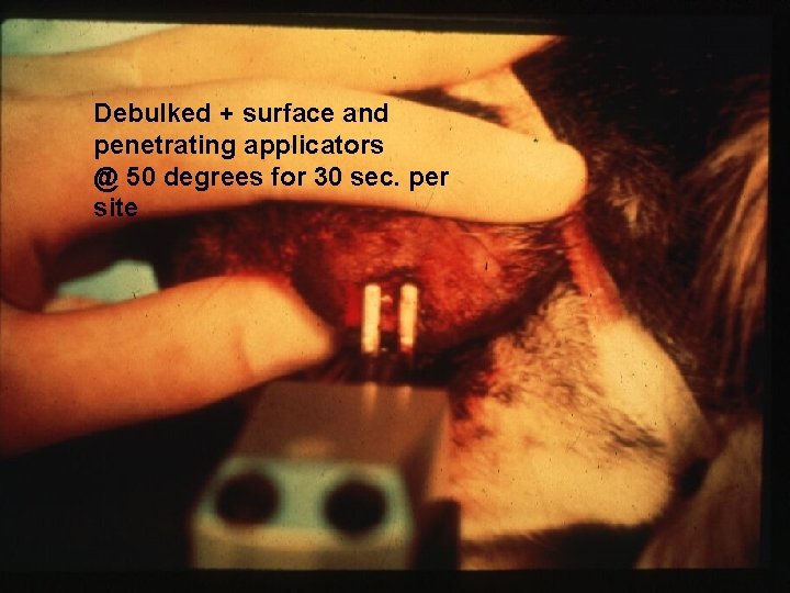 Debulked + surface and penetrating applicators @ 50 degrees for 30 sec. per site