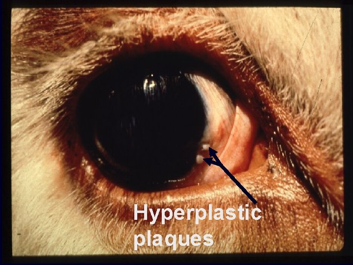 Hyperplastic plaques 