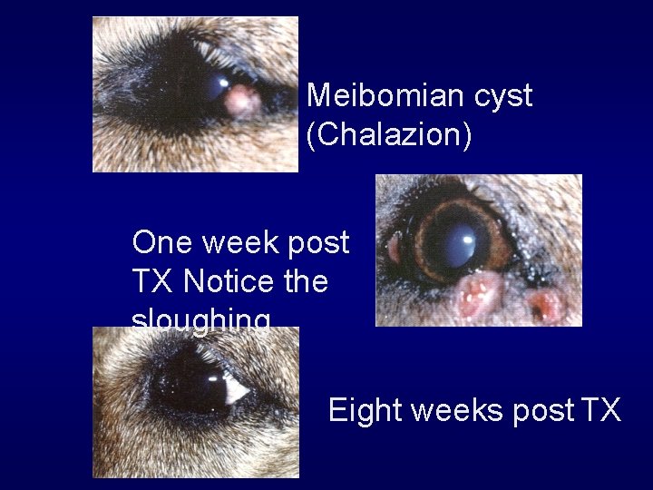 Meibomian cyst (Chalazion) One week post TX Notice the sloughing Eight weeks post TX