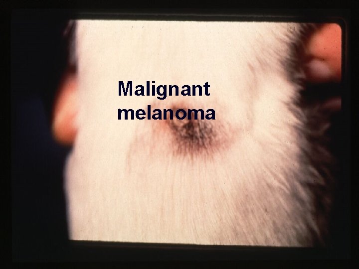 Malignant melanoma 