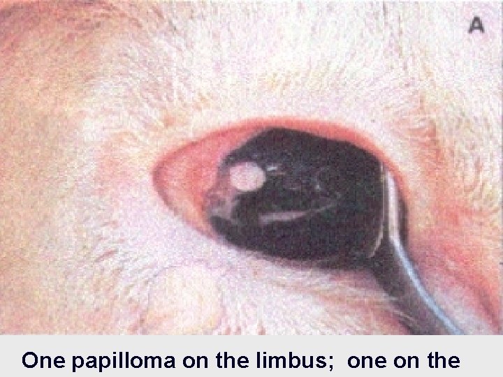 One papilloma on the limbus; one on the 