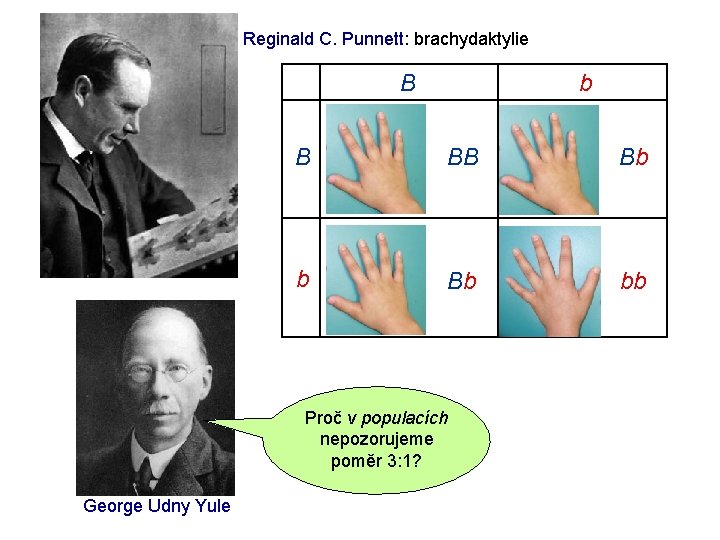 Reginald C. Punnett: brachydaktylie b B B BB Bb bb Proč v populacích nepozorujeme Reginald C. Punnett: brachydaktylie b B B BB Bb bb Proč v populacích nepozorujeme