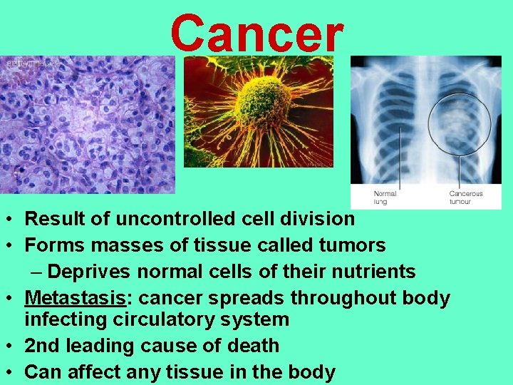 Cancer • Result of uncontrolled cell division • Forms masses of tissue called tumors