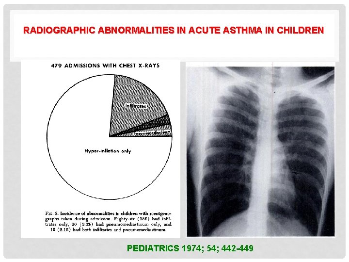 RADIOGRAPHIC ABNORMALITIES IN ACUTE ASTHMA IN CHILDREN PEDIATRICS 1974; 54; 442 -449 