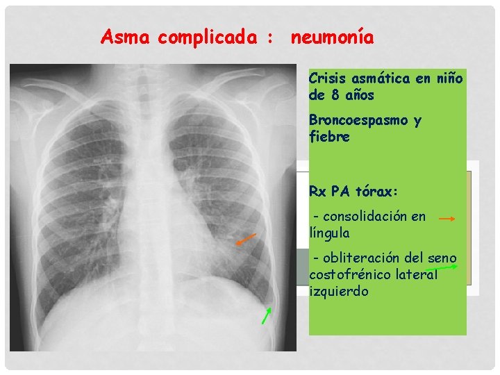 Asma complicada : neumonía Crisis asmática en niño de 8 años Broncoespasmo y fiebre