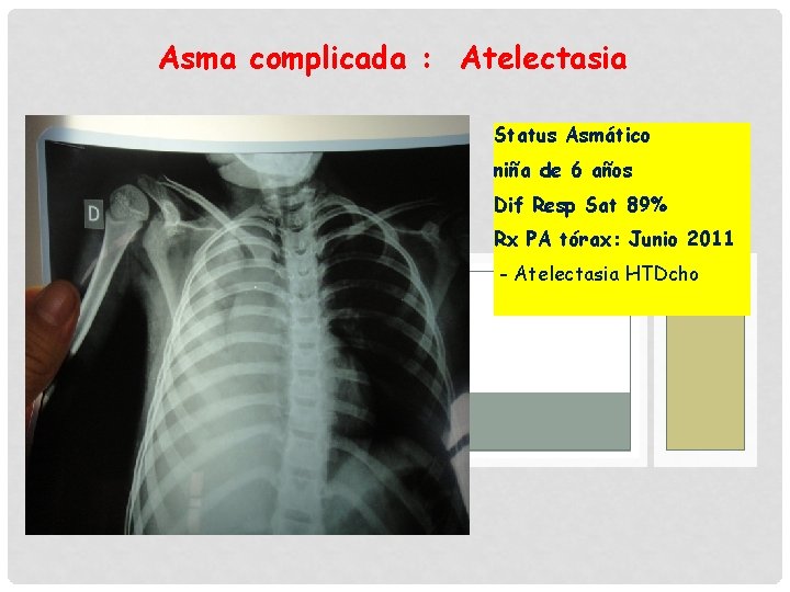Asma complicada : Atelectasia Status Asmático niña de 6 años Dif Resp Sat 89%