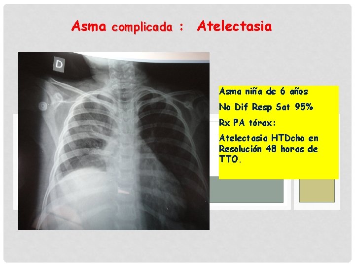Asma complicada : Atelectasia Asma niña de 6 años No Dif Resp Sat 95%