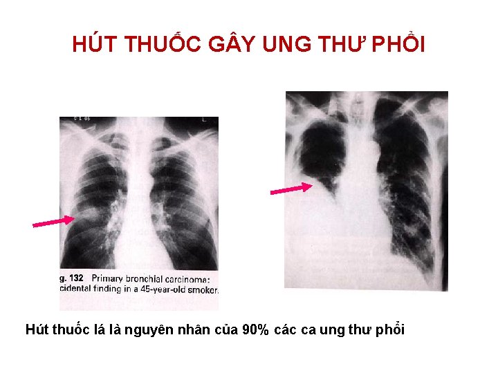 HÚT THUỐC G Y UNG THƯ PHỔI Hút thuốc lá là nguyên nhân của