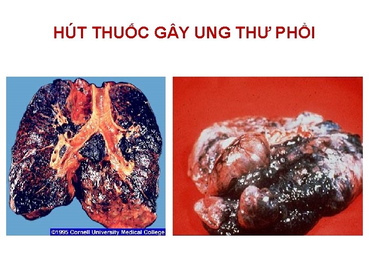 HÚT THUỐC G Y UNG THƯ PHỔI 