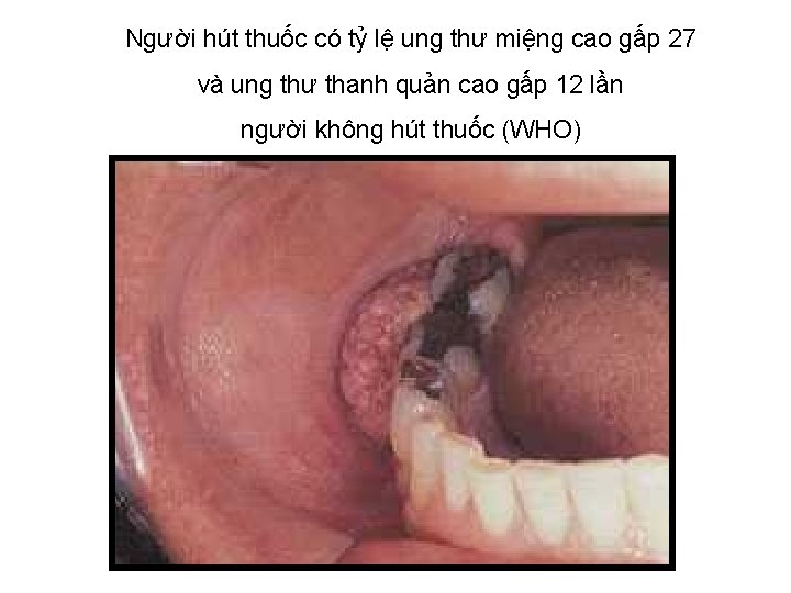 Người hút thuốc có tỷ lệ ung thư miệng cao gấp 27 và ung