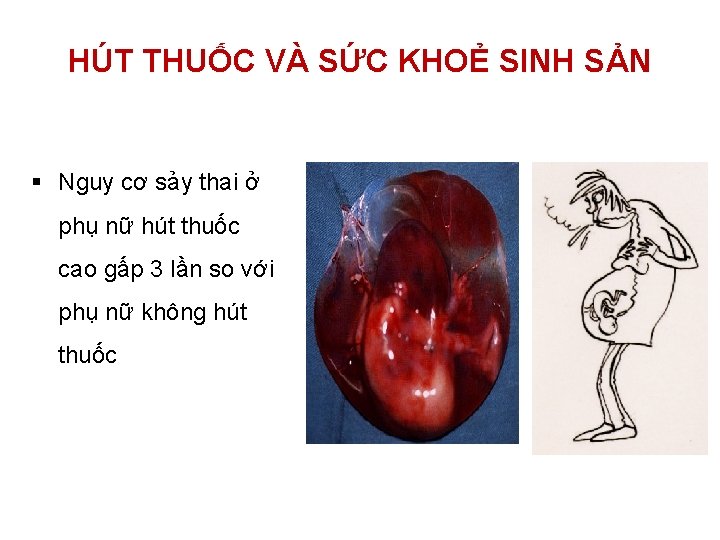 HÚT THUỐC VÀ SỨC KHOẺ SINH SẢN § Nguy cơ sảy thai ở phụ