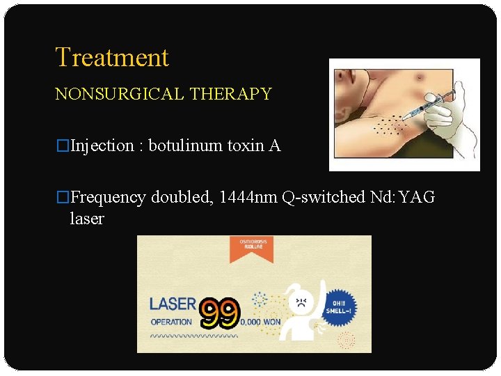 Treatment NONSURGICAL THERAPY �Injection : botulinum toxin A �Frequency doubled, 1444 nm Q-switched Nd: