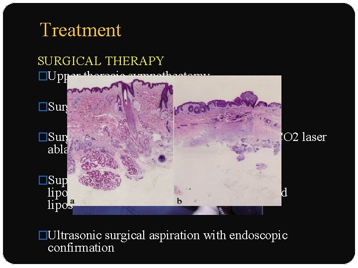 Treatment SURGICAL THERAPY �Upper thoracic sympathectomy �Surgical removal : apocrine glands �Surgical subcutaneous tissue