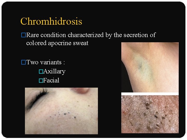 Chromhidrosis �Rare condition characterized by the secretion of colored apocrine sweat �Two variants :