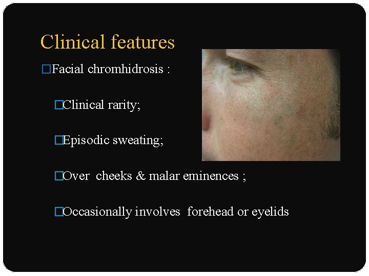 Clinical features �Facial chromhidrosis : �Clinical rarity; �Episodic sweating; �Over cheeks & malar eminences