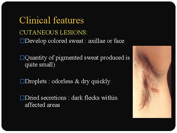 Clinical features CUTANEOUS LESIONS: �Develop colored sweat : axillae or face �Quantity of pigmented