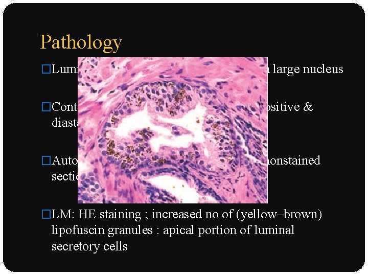 Pathology �Luminal cells : eosinophilic cytoplasm, a large nucleus �Contain lipofuscin, iron, lipid, or