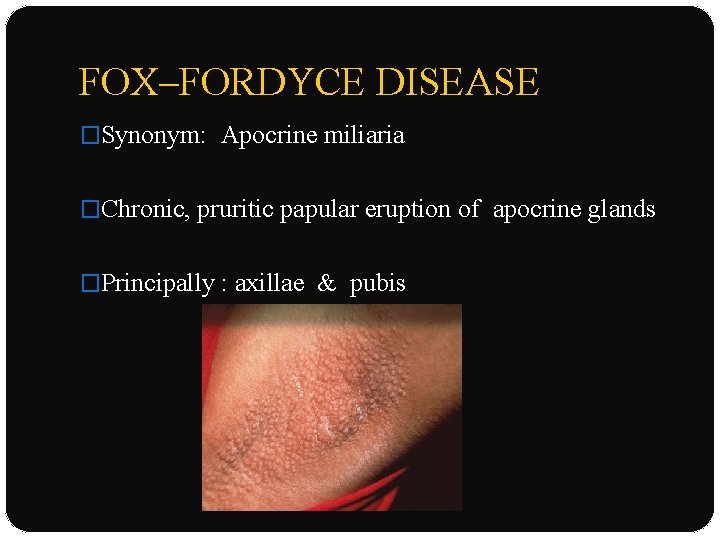 FOX–FORDYCE DISEASE �Synonym: Apocrine miliaria �Chronic, pruritic papular eruption of apocrine glands �Principally :
