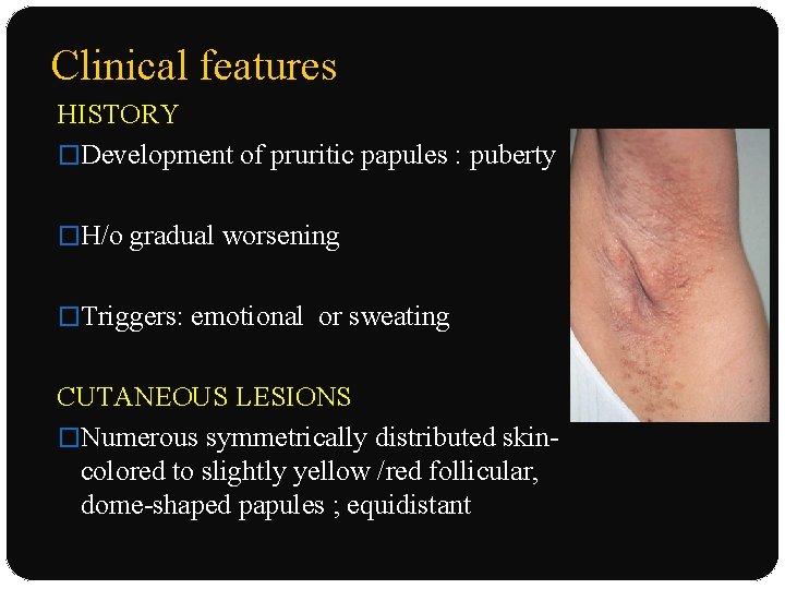 Clinical features HISTORY �Development of pruritic papules : puberty �H/o gradual worsening �Triggers: emotional