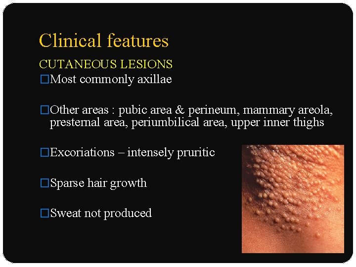 Clinical features CUTANEOUS LESIONS �Most commonly axillae �Other areas : pubic area & perineum,