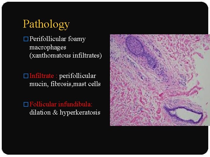 Pathology � Perifollicular foamy macrophages (xanthomatous infiltrates) � Infiltrate : perifollicular mucin, fibrosis, mast