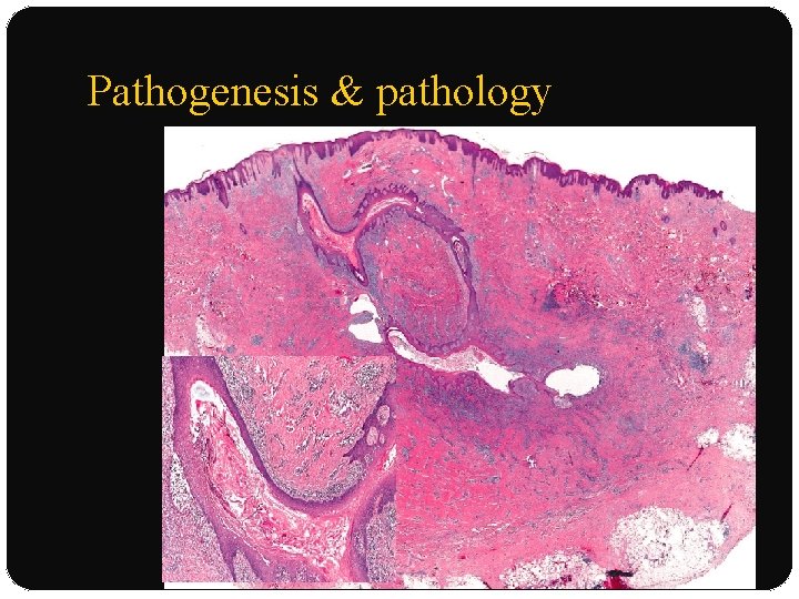 Pathogenesis & pathology 