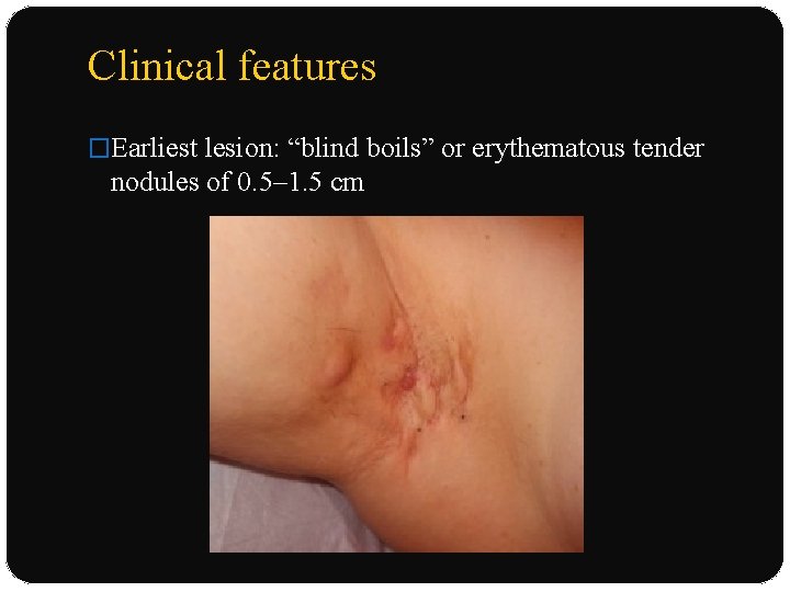 Clinical features �Earliest lesion: “blind boils” or erythematous tender nodules of 0. 5– 1.
