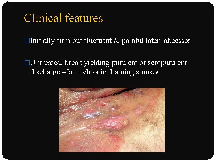 Clinical features �Initially firm but fluctuant & painful later- abcesses �Untreated, break yielding purulent