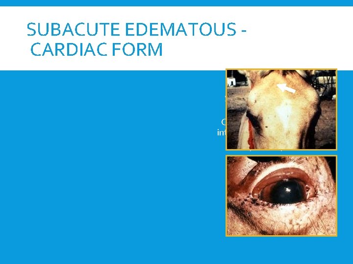 SUBACUTE EDEMATOUS CARDIAC FORM Edema Supraorbital fossae, eyelids Cheeks, lips, tongue, intermandibular space Neck,