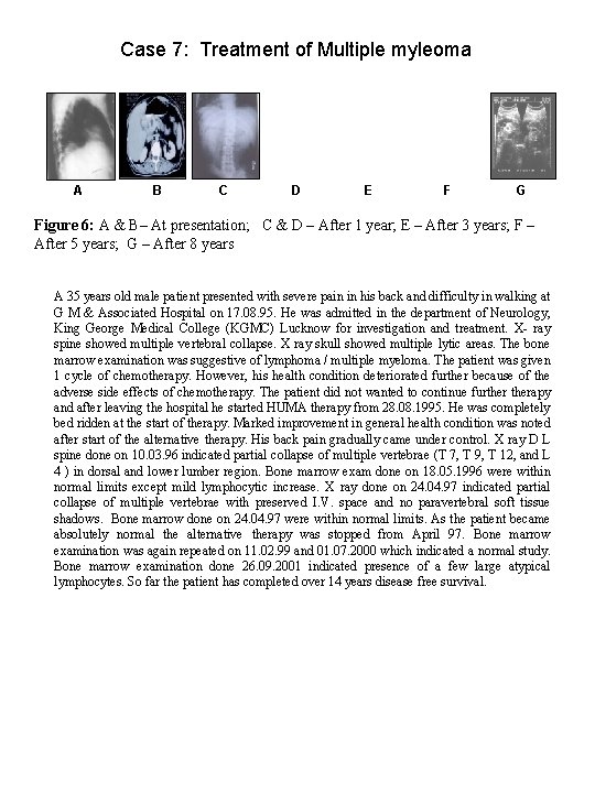 Case 7: Treatment of Multiple myleoma A B C D E F G Figure