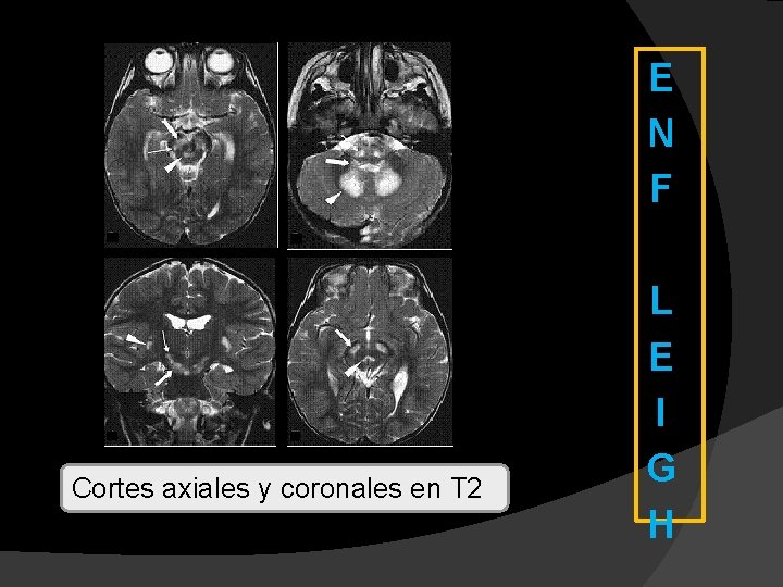 E N F Cortes axiales y coronales en T 2 L E I G