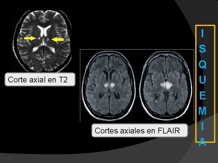 Corte axial en T 2 Cortes axiales en FLAIR I S Q U E