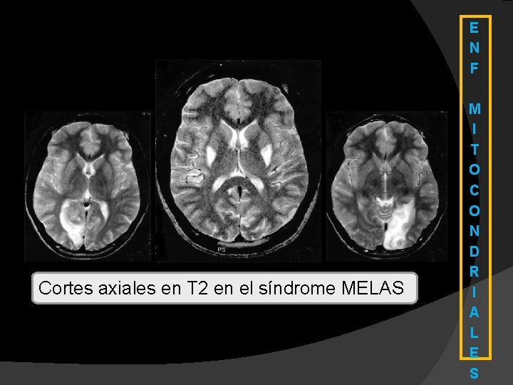 E N F Cortes axiales en T 2 en el síndrome MELAS M I