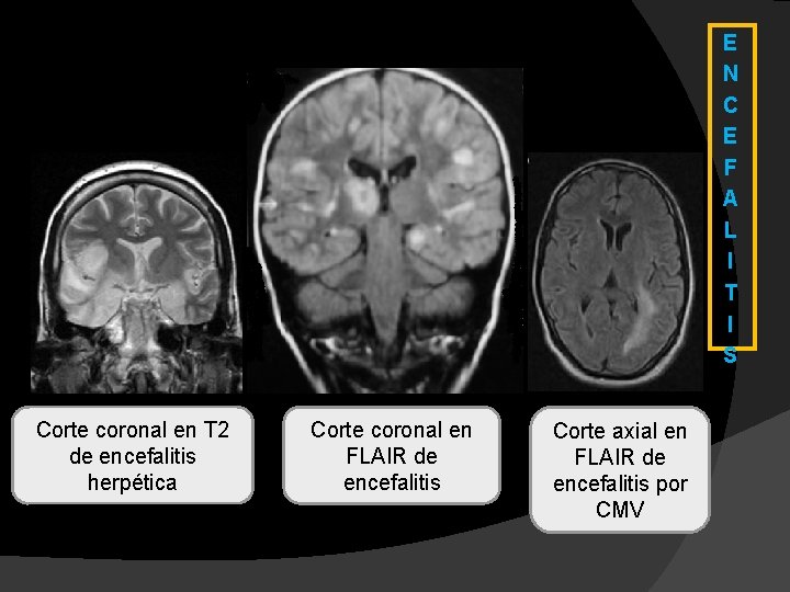 E N C E F A L I T I S Corte coronal en