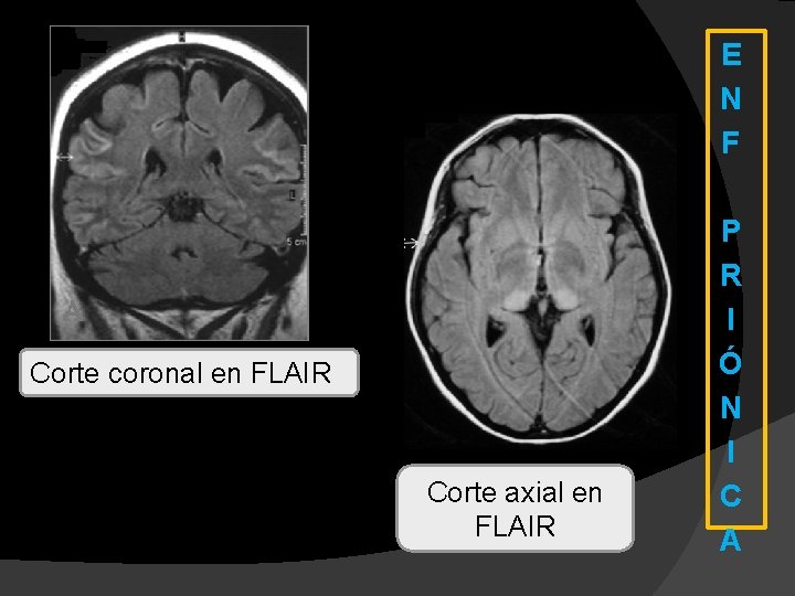 E N F Corte coronal en FLAIR Corte axial en FLAIR P R I