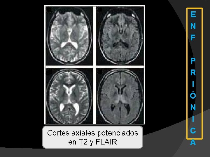 E N F Cortes axiales potenciados en T 2 y FLAIR P R I