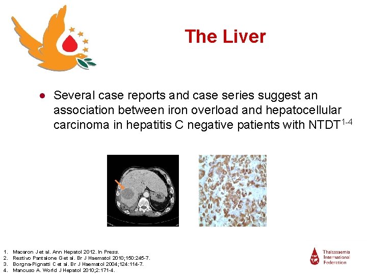 The Liver ● Several case reports and case series suggest an association between iron