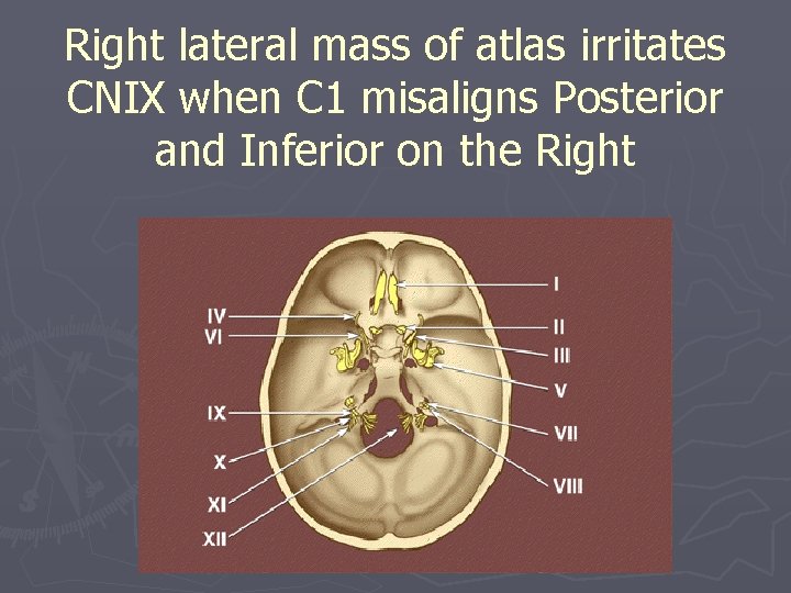 Right lateral mass of atlas irritates CNIX when C 1 misaligns Posterior and Inferior