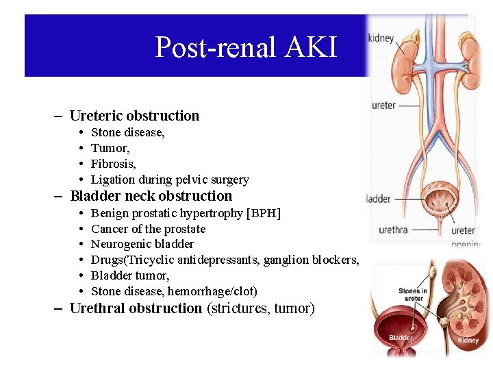 Post-renal AKI – Ureteric obstruction • • Stone disease, Tumor, Fibrosis, Ligation during pelvic