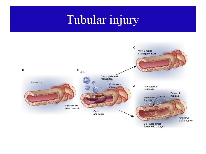 Tubular injury 