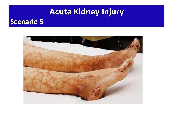 Scenario 5 Acute Kidney Injury 