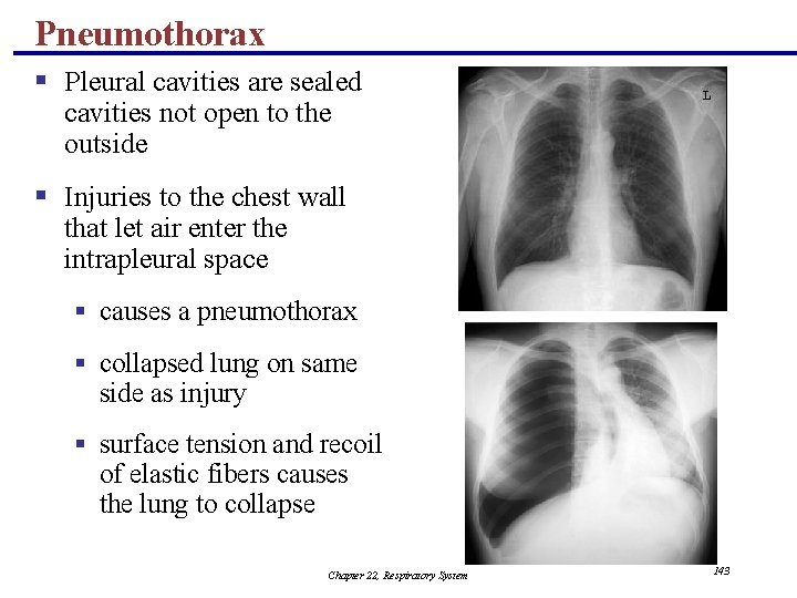 Pneumothorax § Pleural cavities are sealed cavities not open to the outside § Injuries