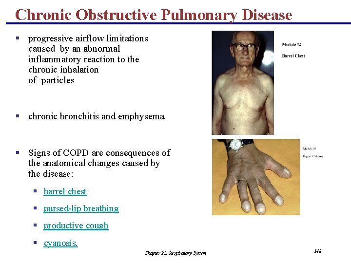 Chronic Obstructive Pulmonary Disease § progressive airflow limitations caused by an abnormal inflammatory reaction