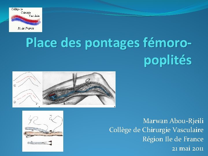 Place des pontages fémoropoplités Marwan Abou-Rjeili Collège de Chirurgie Vasculaire Région Ile de France