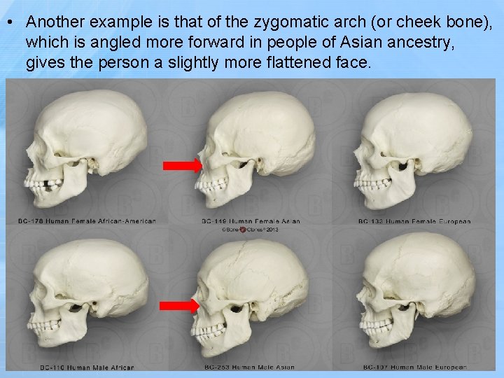  • Another example is that of the zygomatic arch (or cheek bone), which