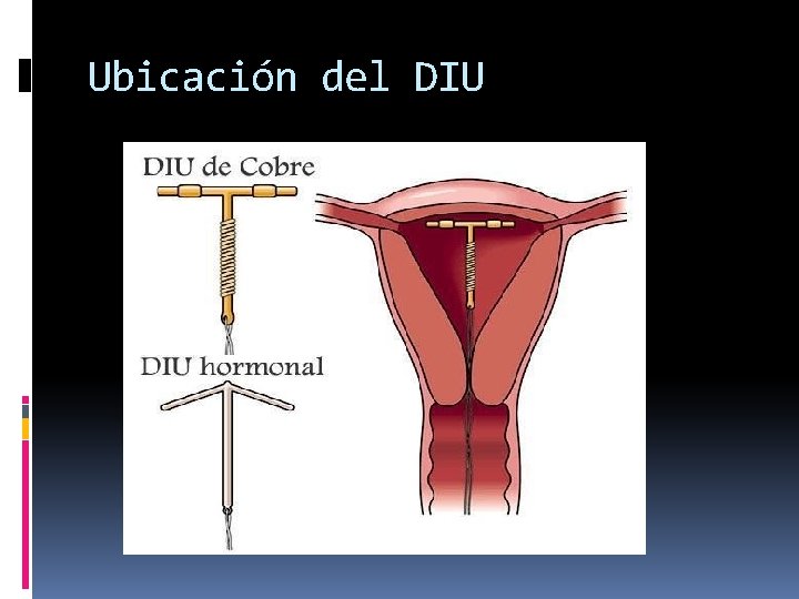 Ubicación del DIU 