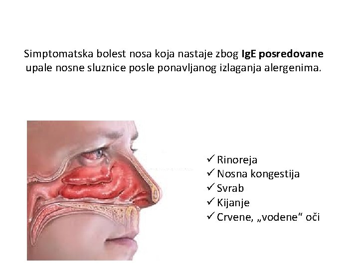 Simptomatska bolest nosa koja nastaje zbog Ig. E posredovane upale nosne sluznice posle ponavljanog