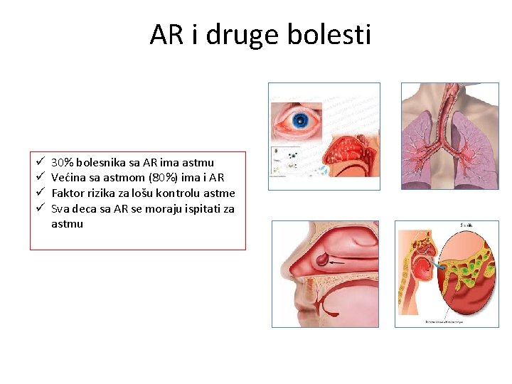 AR i druge bolesti ü ü 30% bolesnika sa AR ima astmu Većina sa