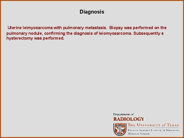 Diagnosis Uterine leimyosarcoma with pulmonary metastasis. Biopsy was performed on the pulmonary nodule, confirming